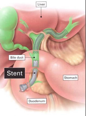 Gastroenteritis Treatment