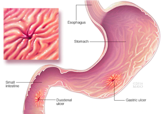 Gastroenteritis Treatment
