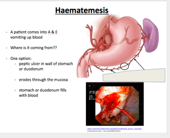 Gastroenteritis Treatment