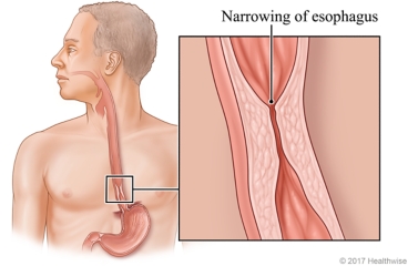 Gastroenteritis Treatment