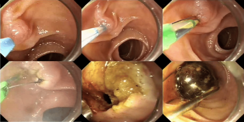 Gastroenteritis Treatment
