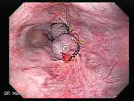 Gastroenteritis Treatment