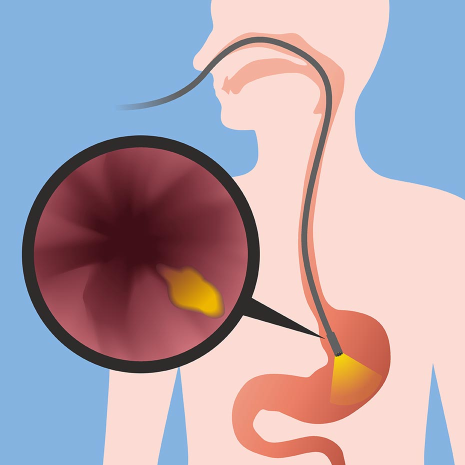 Gastroenteritis Treatment